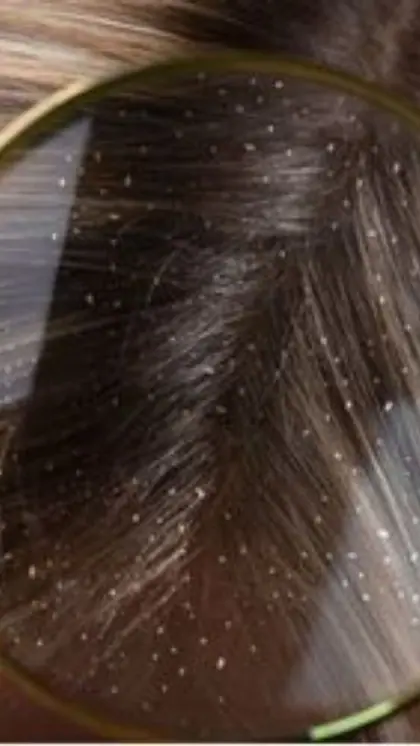 What causes dandruff?