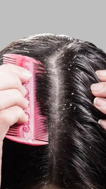 The Ultimate Solution to Dandruff and Scalp Itchiness