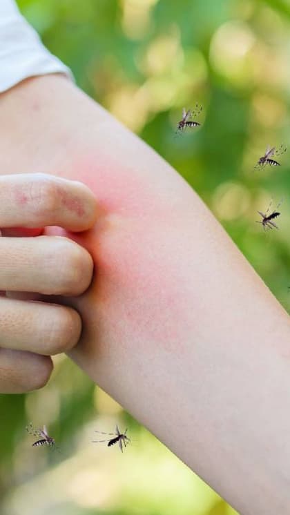 25 अप्रैल को वर्ल्ड मलेरिया डे (World Malaria Day 2024)