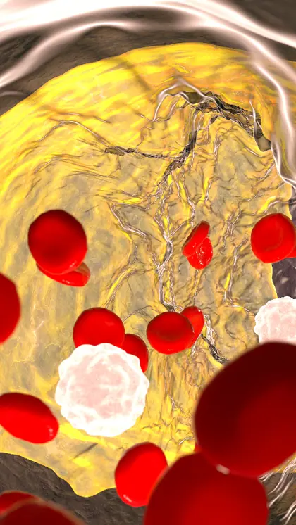 Signs of high cholesterol on the face