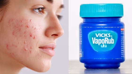 ಮುಖದ ಮೇಲಿನ ಮೊಡವೆಗೆ ವಿಕ್ಸ್ (Vicks) ಹಚ್ಚಬಹುದಾ? ಚರ್ಮರೋಗ ತಜ್ಞರ ಸಲಹೆ ನೀವೂ ತಿಳಿದುಕೊಳ್ಳಿ!