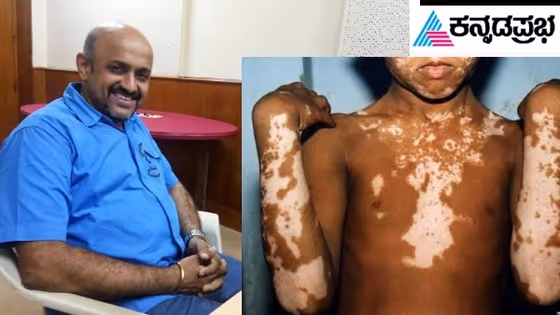 ವಿಶ್ವ ತೊನ್ನು ಜಾಗೃತಿ ದಿನ.. ಜೂನ್ 13 - ತೊನ್ನು ಏನಿದರ ಮರ್ಮ?