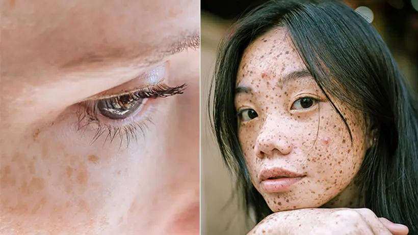 Hyperpigmentation
