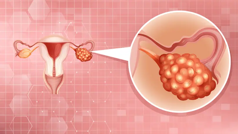 cervical cancer 