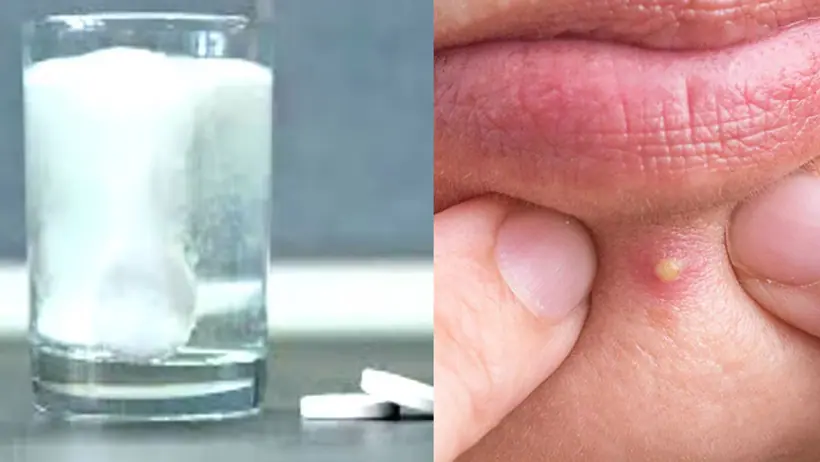 disprin to get rid of pimple and spots