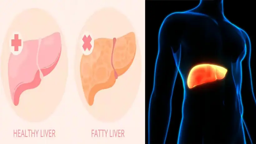 fatty liver 