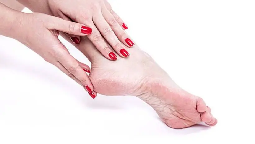 cracked heels