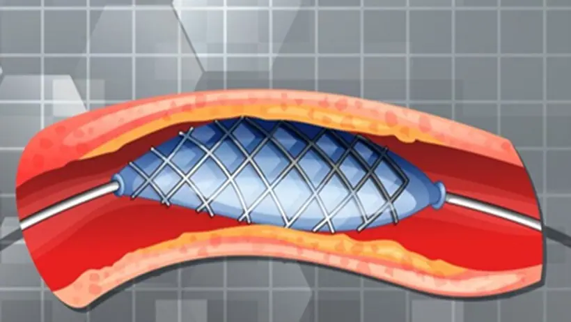 Stent