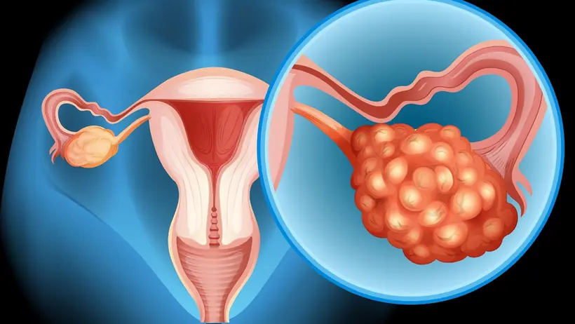 Ovarian Cancer