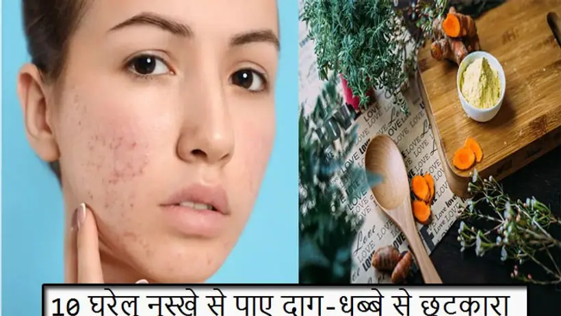 मुंहासों और दाग धब्बों को इन 10 घरेलू नुस्खे से कर सकती हैं दूर, बिना किसी खर्चे के मिलेगा फ्लॉलेस स्किन