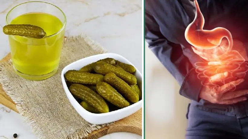  pickle juice benefits in acid reflux 